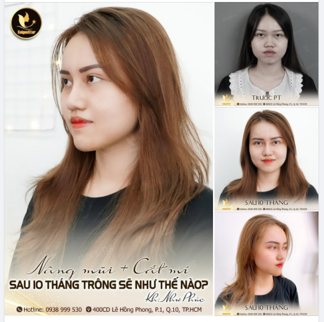 NÂNG MŨI, CẮT MÍ SAU 10 THÁNG SẼ NHƯ THẾ NÀO