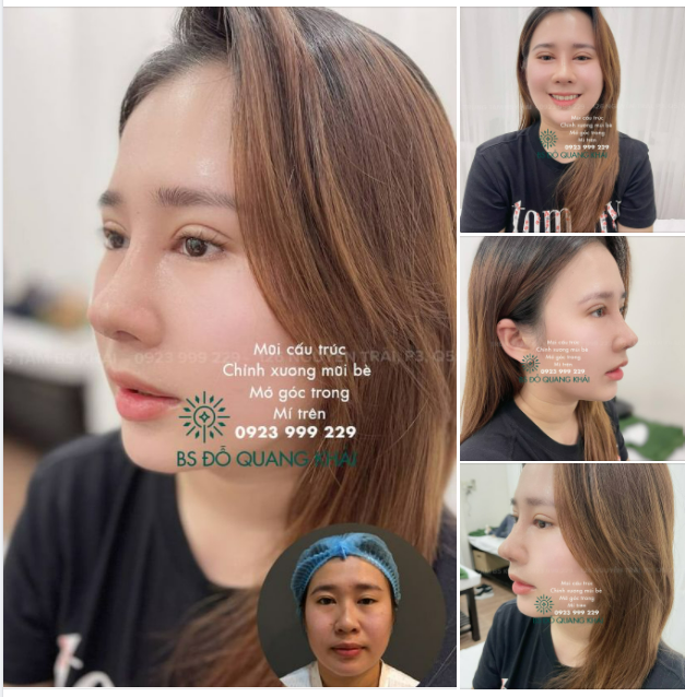 NÂNG MŨI CẮT MÍ XONG CỨ BỊ ĐẸP, BỊ MÊ!
