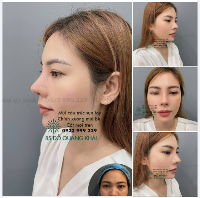 NÂNG MŨI CẤU TRÚC + CHỈNH XƯƠNG + CẮT MÔI TIM 10 NGÀY