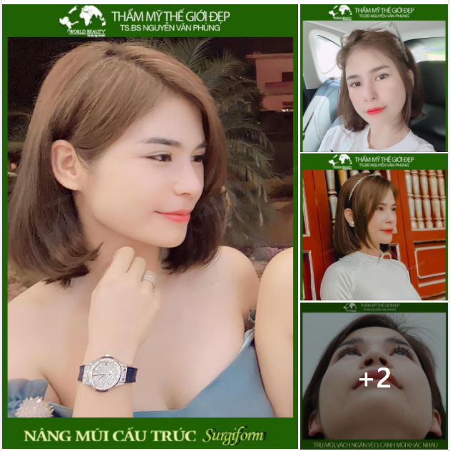 Nâng mũi cấu trúc - Giải pháp hoàn hảo cho mũi lệch, vách ngăn vẹo yếu