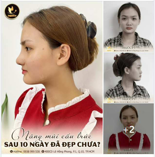 NÂNG MŨI CẤU TRÚC SAU 10 NGÀY ĐÃ ĐẸP CHƯA