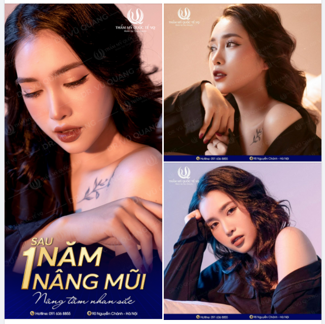 Nâng mũi cấu trúc Softline đã mang lại cho bạn những gì
