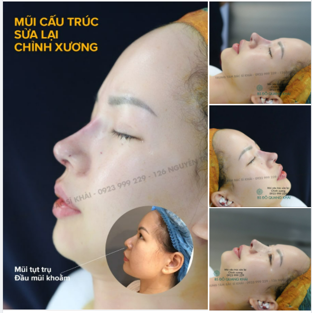 NÂNG MŨI CẤU TRÚC SỬA LẠI KẾT HỢP CHỈNH XƯƠNG