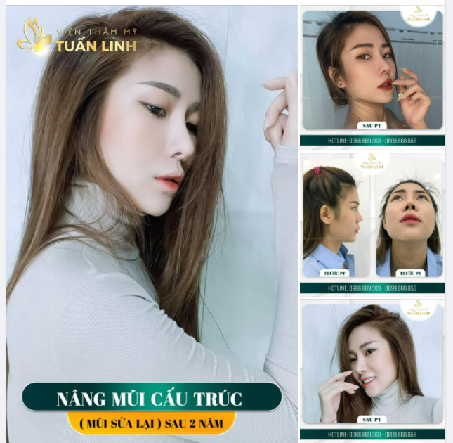 NÂNG MŨI CẤU TRÚC SỬA LẠI SAU 2 NĂM !