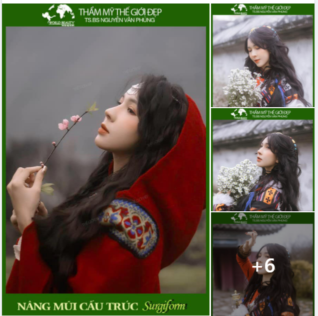 Nâng mũi cấu trúc Surgiform - phương pháp làm đẹp được các Hotgirl ưa chuộng