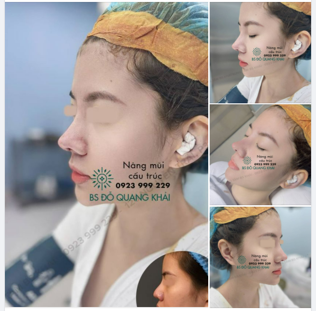 NÂNG MŨI CẤU TRÚC VỪA THỰC HIỆN XONG BỞI BÁC SĨ KHẢI
