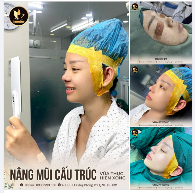 NÂNG MŨI CẤU TRÚC VỪA THỰC HIỆN XONG - CÔ GÁI CƯỜI MÃN NGUYỆN VÌ KẾT QUẢ QUÁ ĐẸP