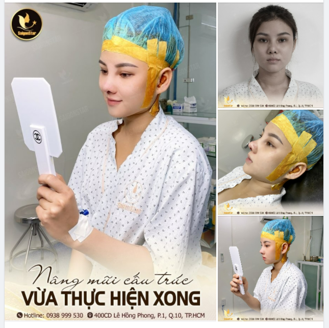 NÂNG MŨI CẤU TRÚC VỪA THỰC HIỆN XONG - ĐẸP MỸ MÃN