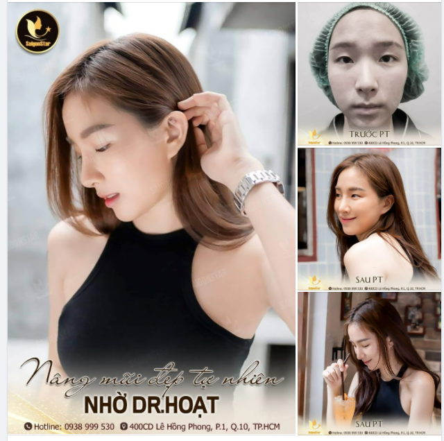 NÂNG MŨI ĐẸP TỰ NHIÊN NHỜ DR.HOẠT