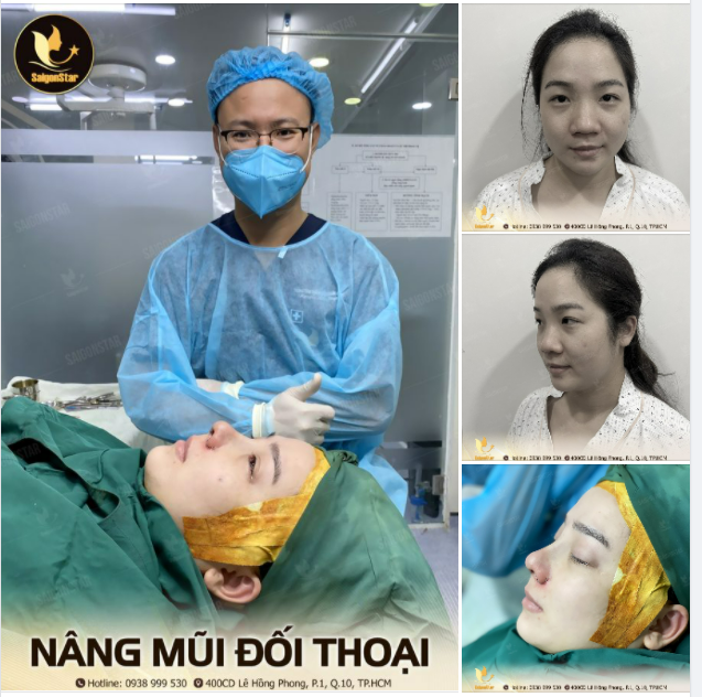 NÂNG MŨI ĐỐI THOẠI CÙNG DR.HOẠT
