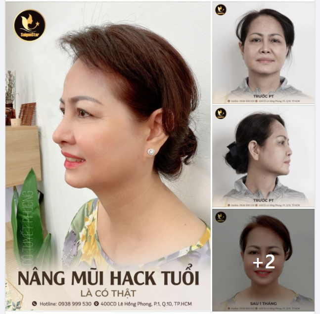 NÂNG MŨI HACK TUỔI LÀ CÓ THẬT - TRÔNG CÔ TRẺ TRUNG HƠN RẤT NHIỀU