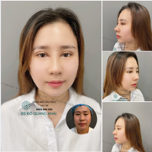 NÂNG MŨI KẾT HỢP CẮT MÍ CÙNG LÚC SẼ NHƯ THẾ NÀO