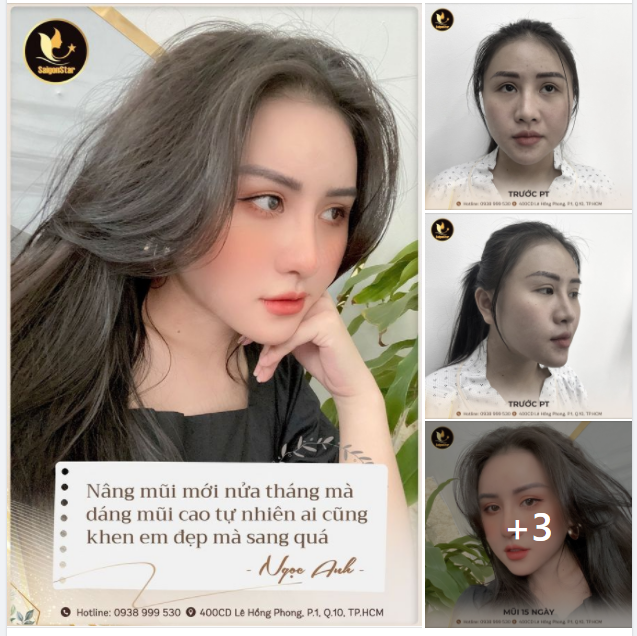 ​​​​​​​Nâng mũi mới nửa tháng mà dáng mũi cao tự nhiên ai cũng khen em đẹp mà sang quá trời - Chia sẻ của Ngọc Anh