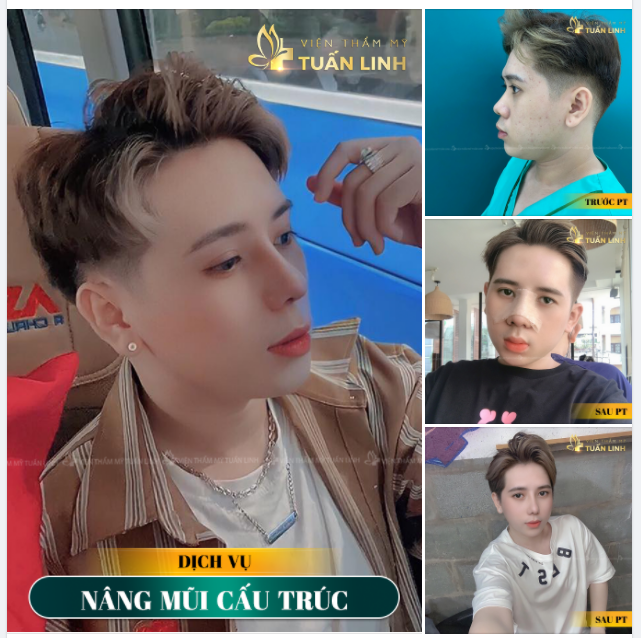 NÂNG MŨI NAM - NÂNG TẦM TỰ TIN, BẢN LĨNH CHO NAM GIỚI.