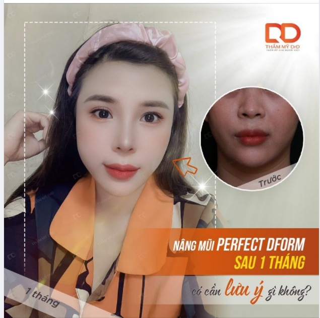 Nâng mũi Perfect Dform sau 1 tháng còn cần lưu ý gì không