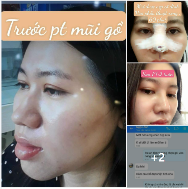 Nâng mũi phong thủy là chỉnh sửa dáng mũi cho hợp với nhân tướng học.