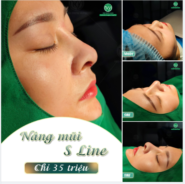 NÂNG MŨI S LINE ​​​​​​​ DUY NHẤT 10 SUẤT 35TRIỆU