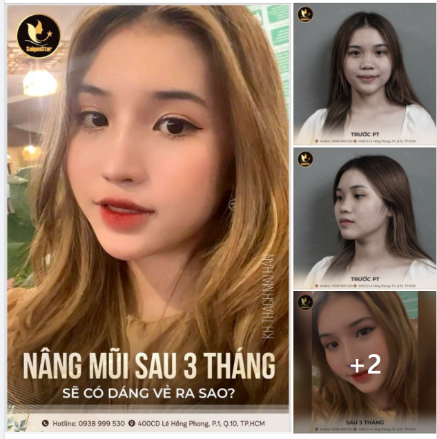 NÂNG MŨI SAU 3 THÁNG SẼ CÓ DÁNG VẺ RA SAO