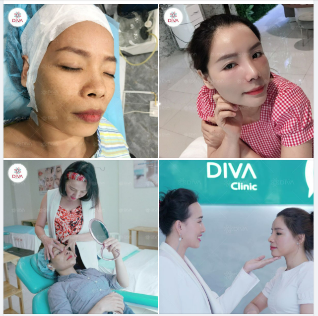 NÂNG MŨI SLINE SỤN TỰ THÂN NÂNG TẦM NHAN SẮC
