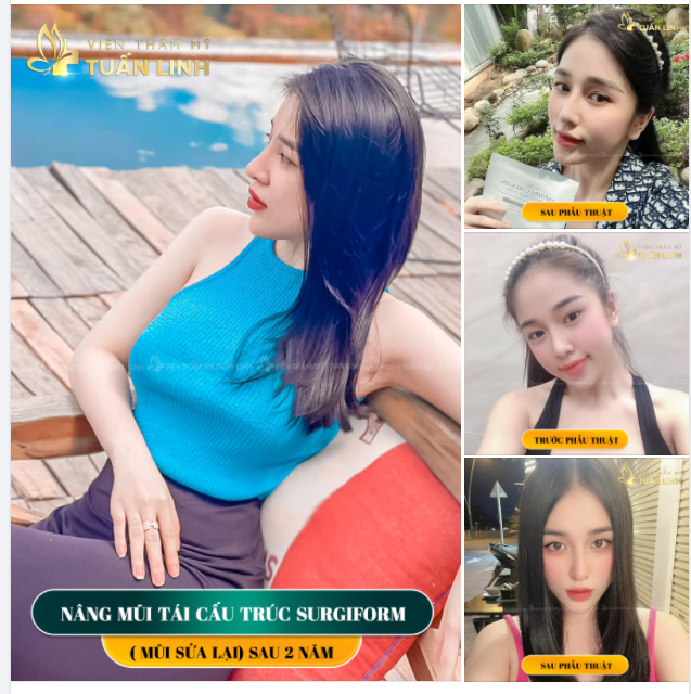 NÂNG MŨI SỬA LẠI TẠI TUẤN LINH - DÁNG MŨI SAU 2 NĂM !!!