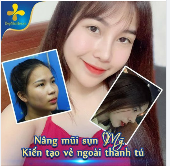 NÂNG MŨI SỤN MỸ - XÓA KHUYẾT ĐIỂM, TẠO NÉT ĐẸP