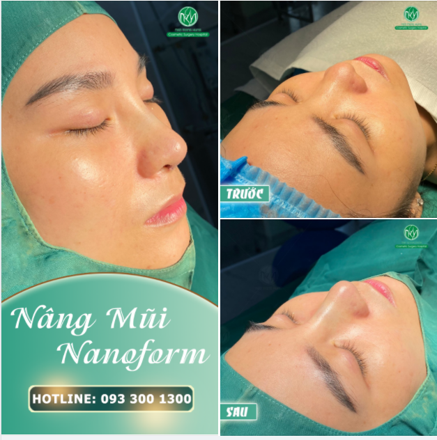 NÂNG MŨI SỤN NANOFORM - ĐẸP CHUẨN TỶ LỆ