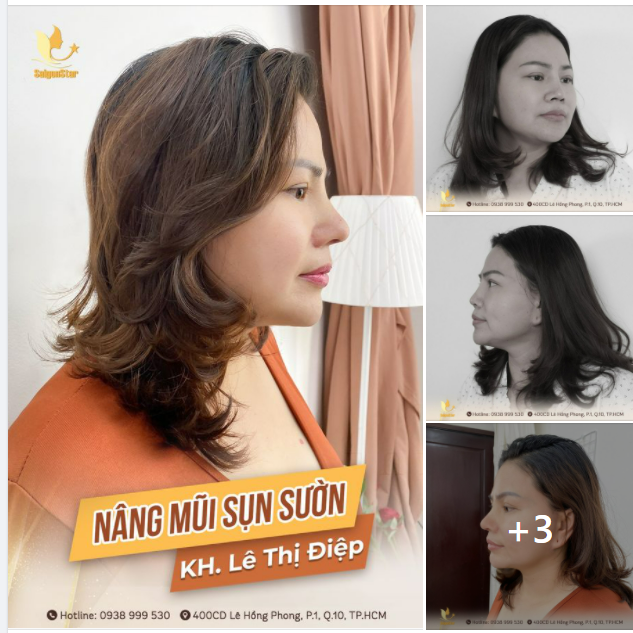 NÂNG MŨI SỤN SƯỜN 10 NGÀY