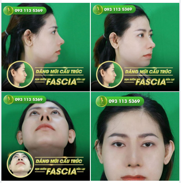 nâng mũi