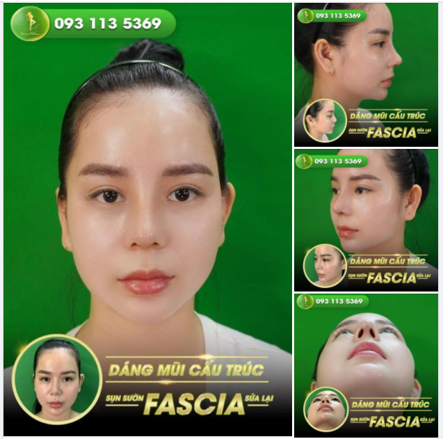 NÂNG MŨI SỤN SƯỜN FASCIA - ĐẲNG CẤP LÀ MÃI MÃI