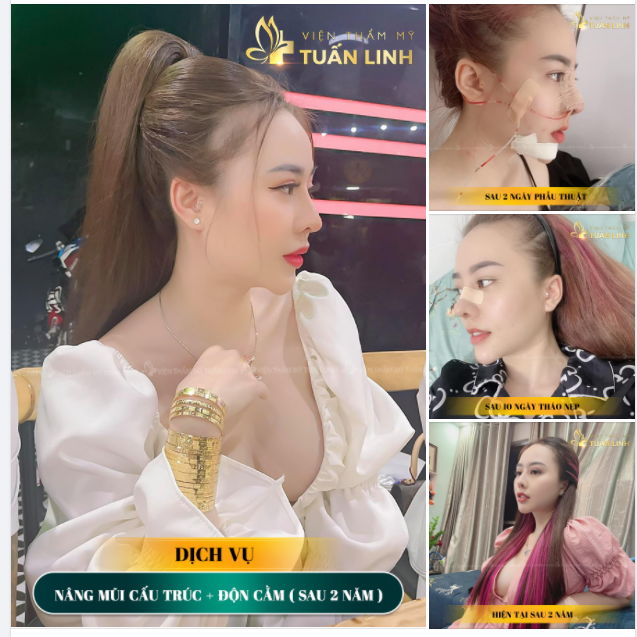 Nâng mũi tại Tuấn Linh có bền đẹp không . Xem ngay câu trả lời ở bên dưới nha cả nhà.