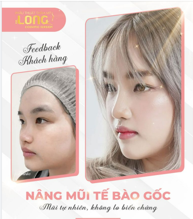 NÂNG MŨI ƯU ĐÃI SÂU - ĐẸP BỀN LÂU - KHÔNG CẦN PHẪU THUẬT