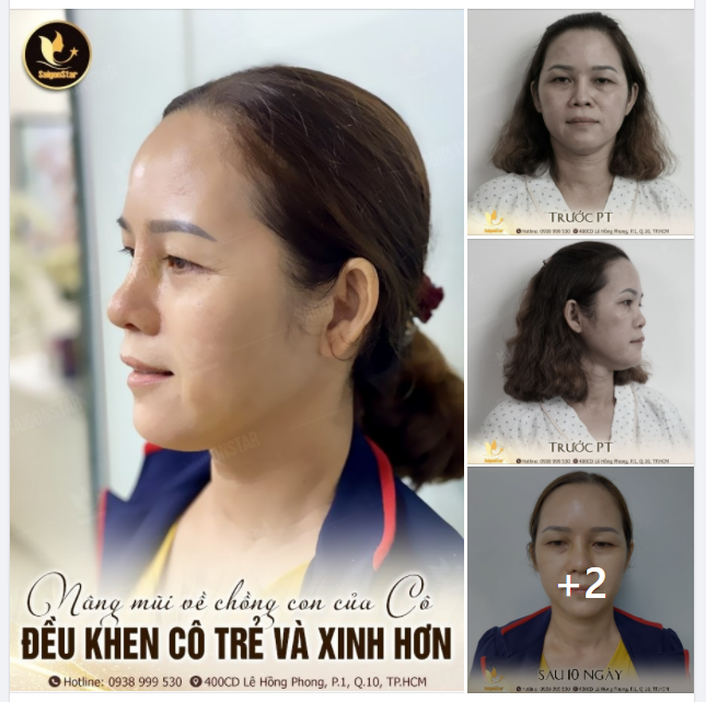 NÂNG MŨI VỀ CHỒNG CON CỦA CÔ ĐỀU KHEN CÔ TRẺ VÀ XINH HƠN - Cô Nhung chia sẻ với nhân viên của Bs.Hoạt