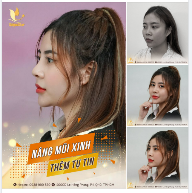 NÂNG MŨI XINH – THÊM TỰ TIN