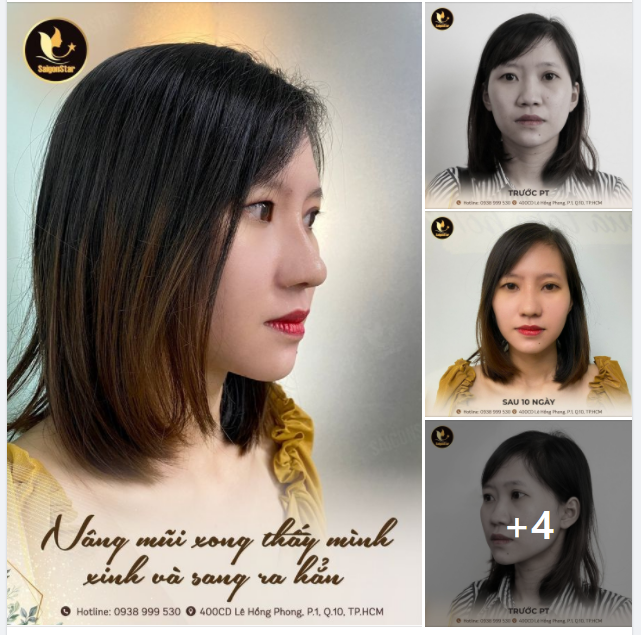 Nâng mũi xong thấy mình xinh và sang ra hẳn