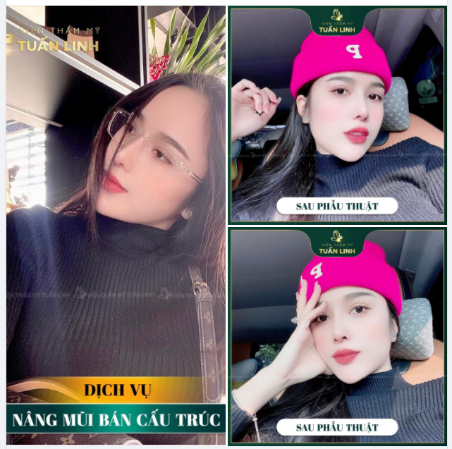 ''Nâng mũi xong xinh quá - Hối hận vì đã không làm sớm hơn'' . Là chia sẻ của cô gái 29 tuổi sau nâng mũi bán cấu trúc tại Tuấn Linh.