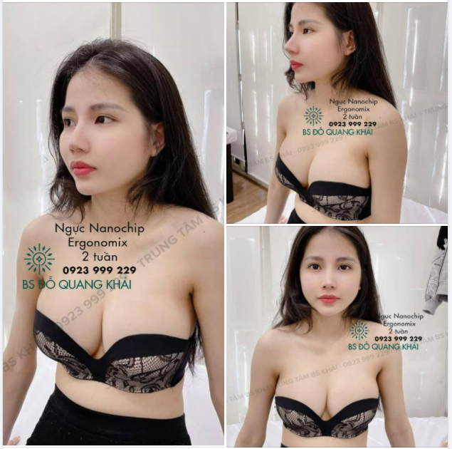 NÂNG NGỰC CHỈ 1 LẦN DUY NHẤT - ĐẸP MÃI VỚI THỜI GIAN