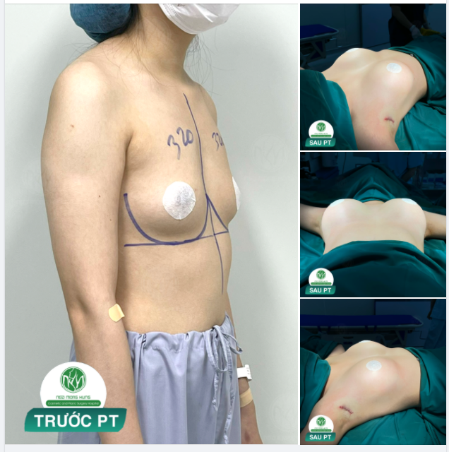 NÂNG NGỰC ĐẸP VÀ AN TOÀN TẠI BVTM NGÔ MỘNG HÙNG