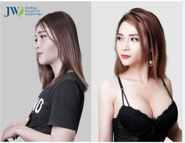 NÂNG NGỰC GOLDEN LINE - NÂNG CẤP VÒNG 1 QUYẾN RŨ, CĂNG TRÀN TỰ TIN