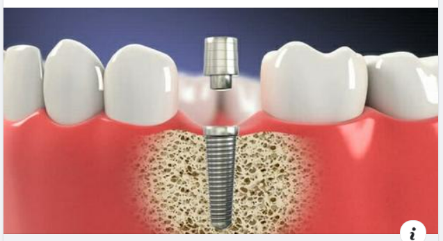 Nếu bạn có ý định cấy Implant nhưng vẫn còn nhiều thắc mắc, e ngại liên quan đến kỹ thuật thì bài viết này sẽ giải đáp giúp bạn những vấn đề thưởng gặp.
