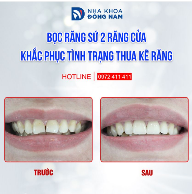 NẾU CHỈ NHÌN KẾT QUẢ, BẠN CÓ NHẬN RA ĐÂU LÀ RĂNG SỨ THẨM MỸ