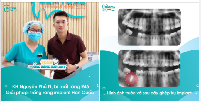 NẾU MẤT RĂNG, BẠN SẼ CHỌN CÁCH CẢI THIỆN NHƯ THẾ NÀO 