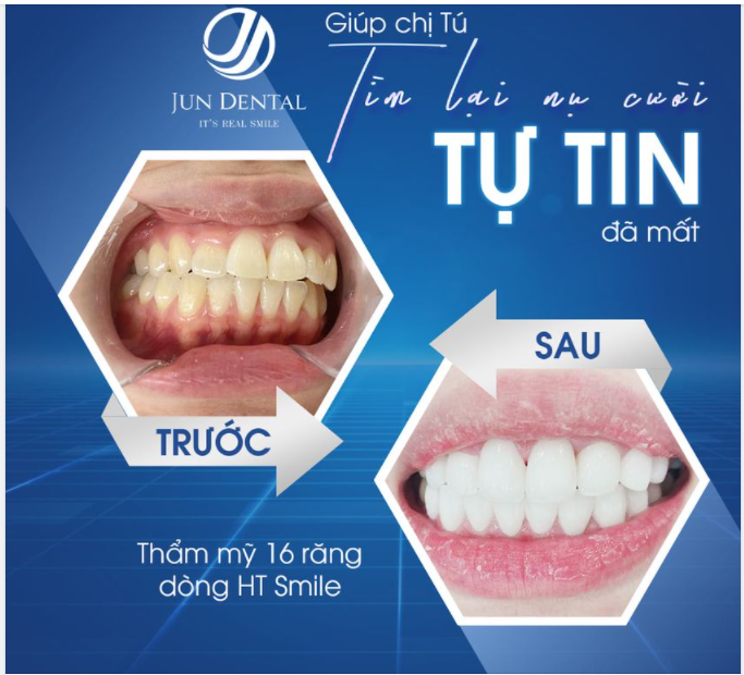 NẾU RĂNG BẠN ĐANG GẶP 6 TÌNH TRẠNG SAU ĐÂY, HÃY BỌC SỨ CHO RĂNG