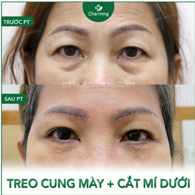 Nếu xăm chân mày mà bị lỗi thì sao Nếu tuổi tác làm cho phần da chùng và bọng mỡ dưới mắt xuất hiện càng nhiều, khiến đôi mắt lờ đờ, thiếu sức sống thì phải thế nào