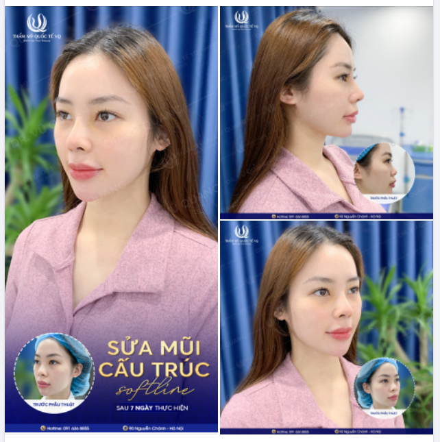 NGẠC NHIÊN CHƯA - Nhan sắc lên 1 tầm cao mới chỉ sau 7 ngày sửa mũi