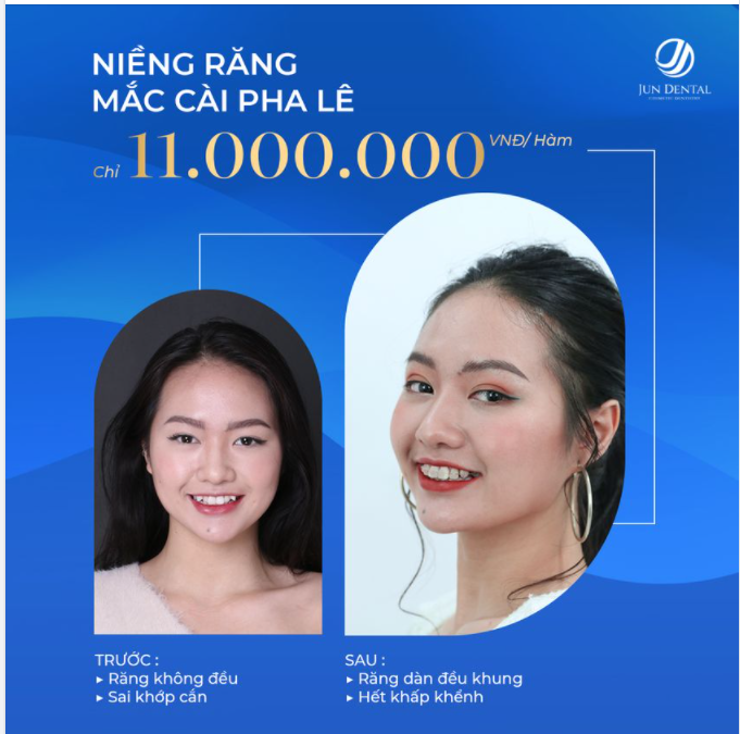 Ngại niềng răng có thể khiến bạn hối hận cả đời!!!