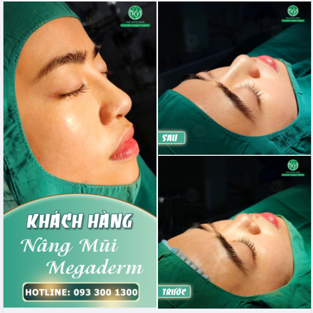NGẮM TRỌN DÁNG MŨI MEGADERM NGAY SAU PT