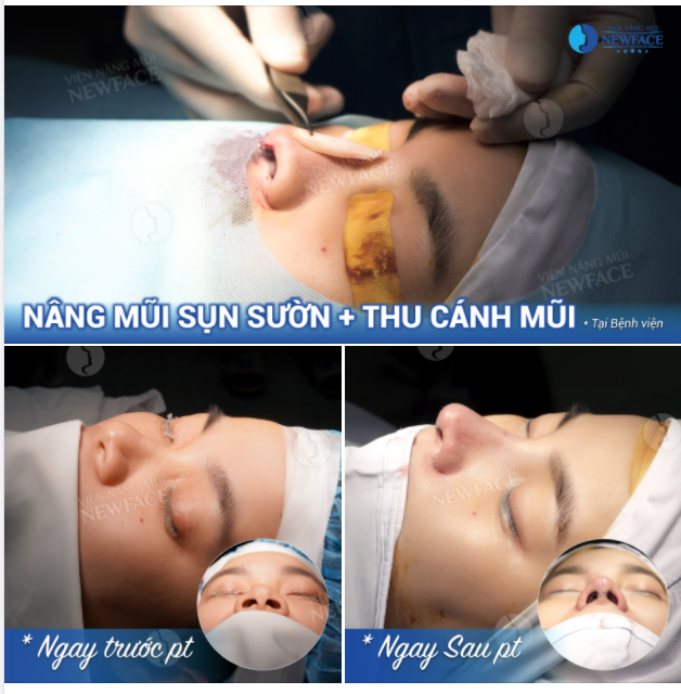 “NGOẠN MỤC” CA NÂNG MŨI SỤN SƯỜN + CUỘN CÁNH MŨI TRONG