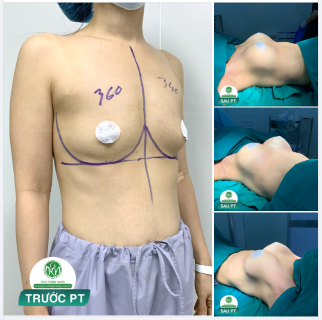 NGỰC ĐẶT TÚI KẾ HỢP THU QUẦNG V.Ú CHO KH 40 TUỔI