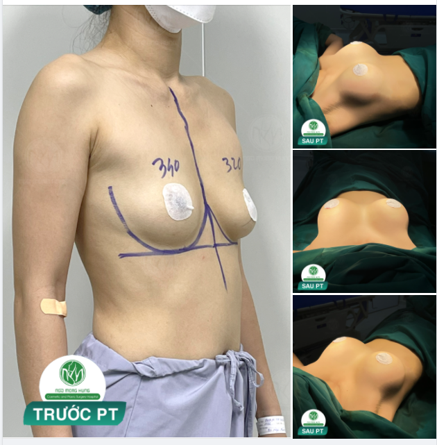 NGỰC ĐẸP CHO KH 36 TUỔI CAO 1M57