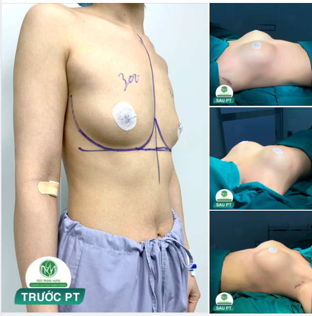 NGỰC ĐẸP SAU NHIỀU NĂM ẤP Ủ